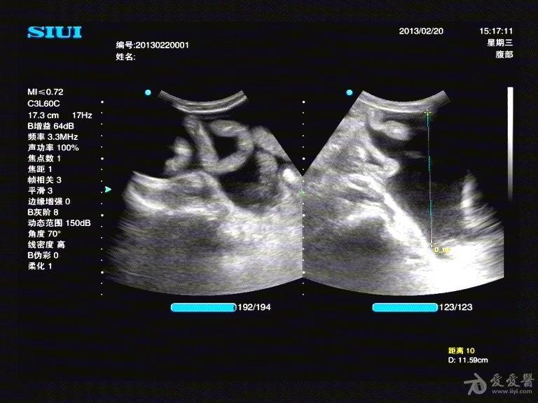 3,超声意见:   1,肝硬化并大量腹水形成?(建议
