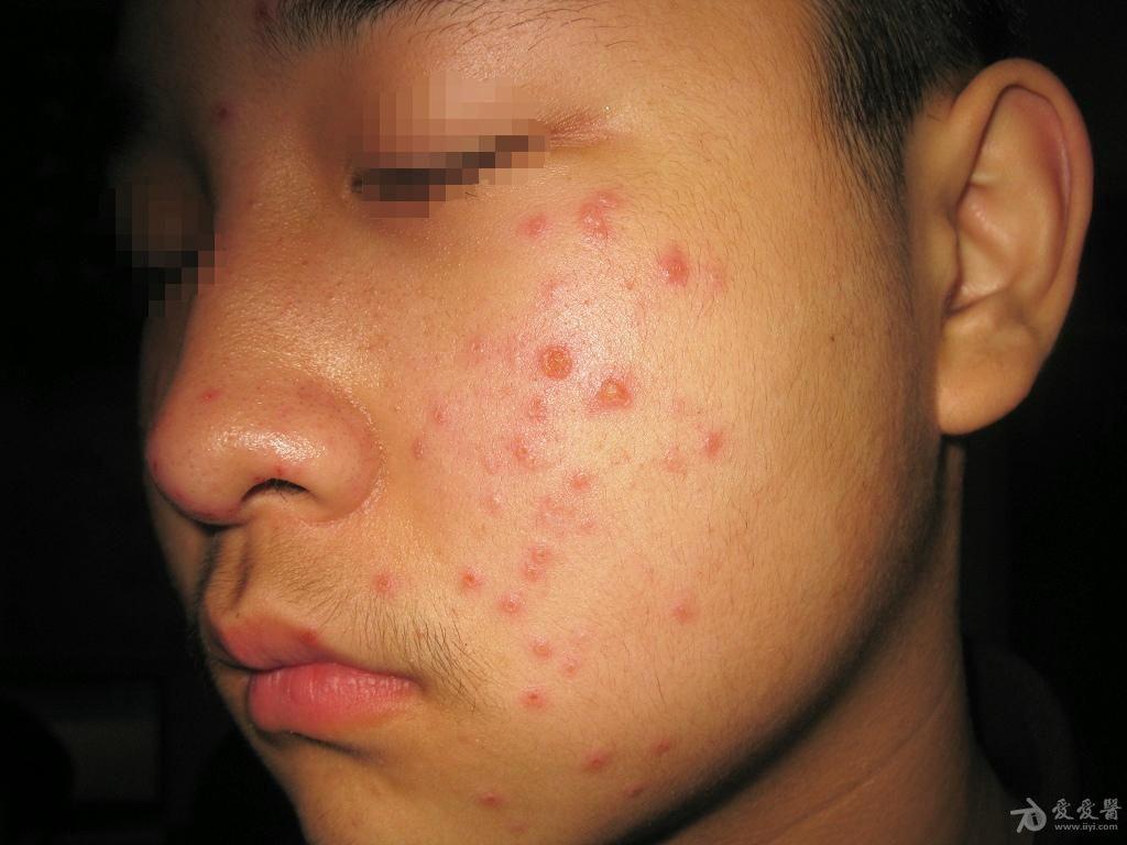 颜面部水疱疹3天,微痒,无发热,耳后淋巴结不肿大.血常规正常.