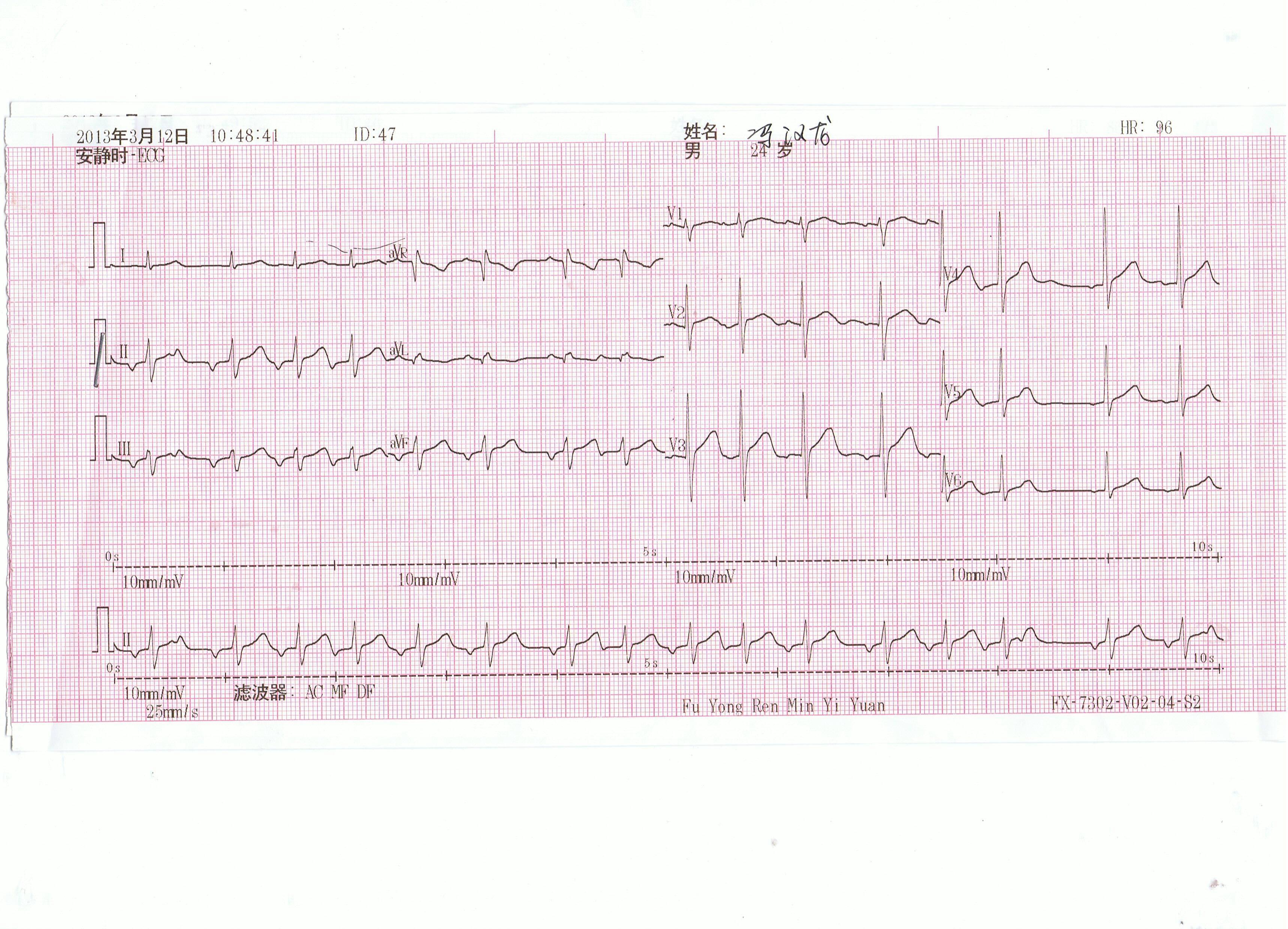 这份心电图诊断什么?