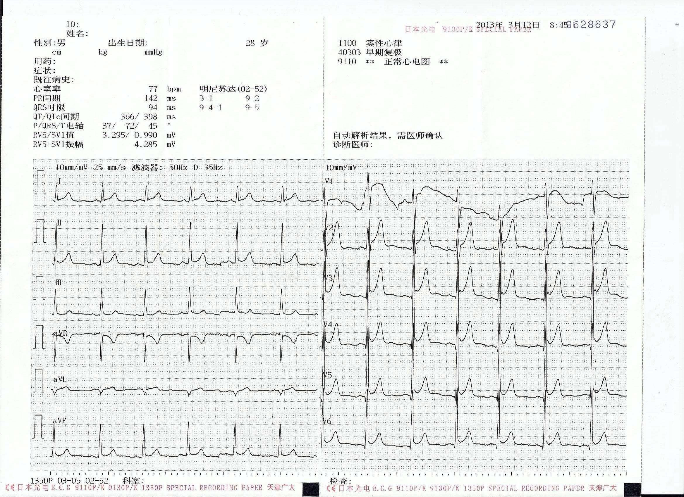 请帮忙看一张心电图