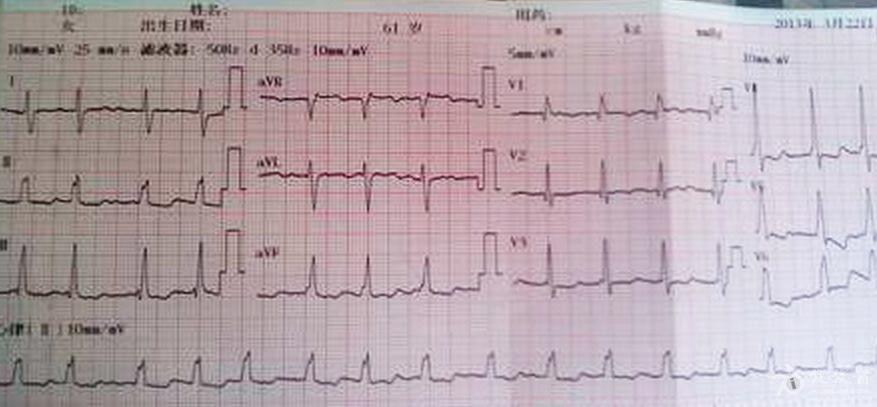 leiheku-肺动脉高压者心电图.jpg