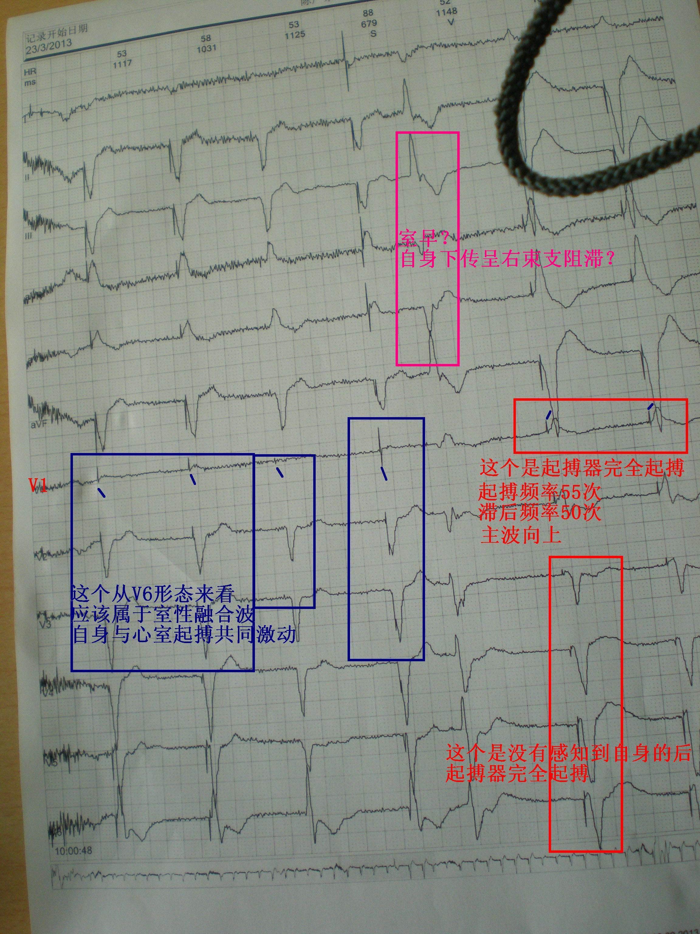 起搏器动态心电图怎么看