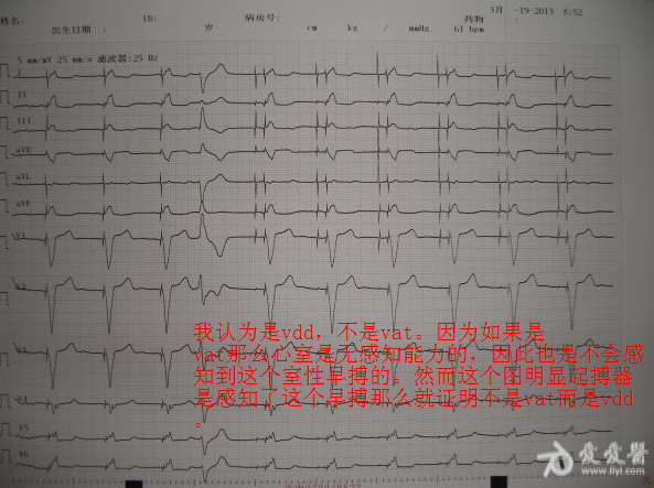 帮忙看看起搏器心电图 起搏器诊断   如 3楼wyl123123老师所言  双腔