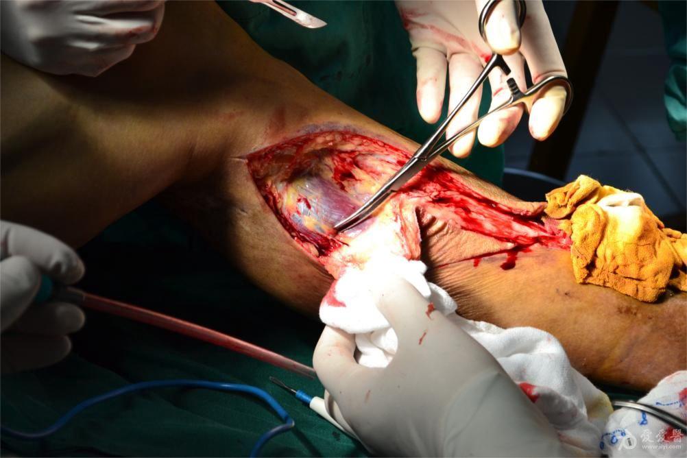 左胫腓骨开放性骨折内固定术后20天术后切口周围红肿少许渗液9天入院
