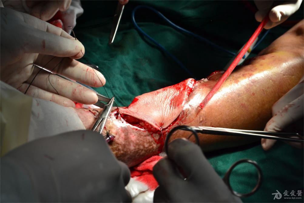 左胫腓骨开放性骨折内固定术后20天术后切口周围红肿少许渗液9天入院