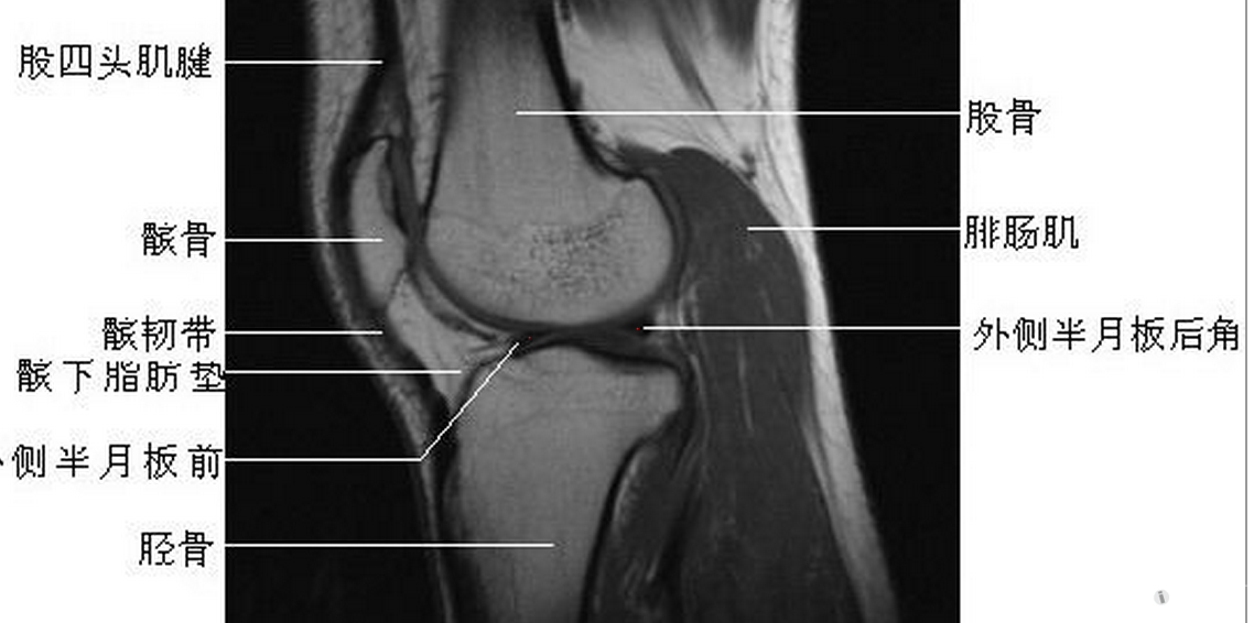 正常半月板mri