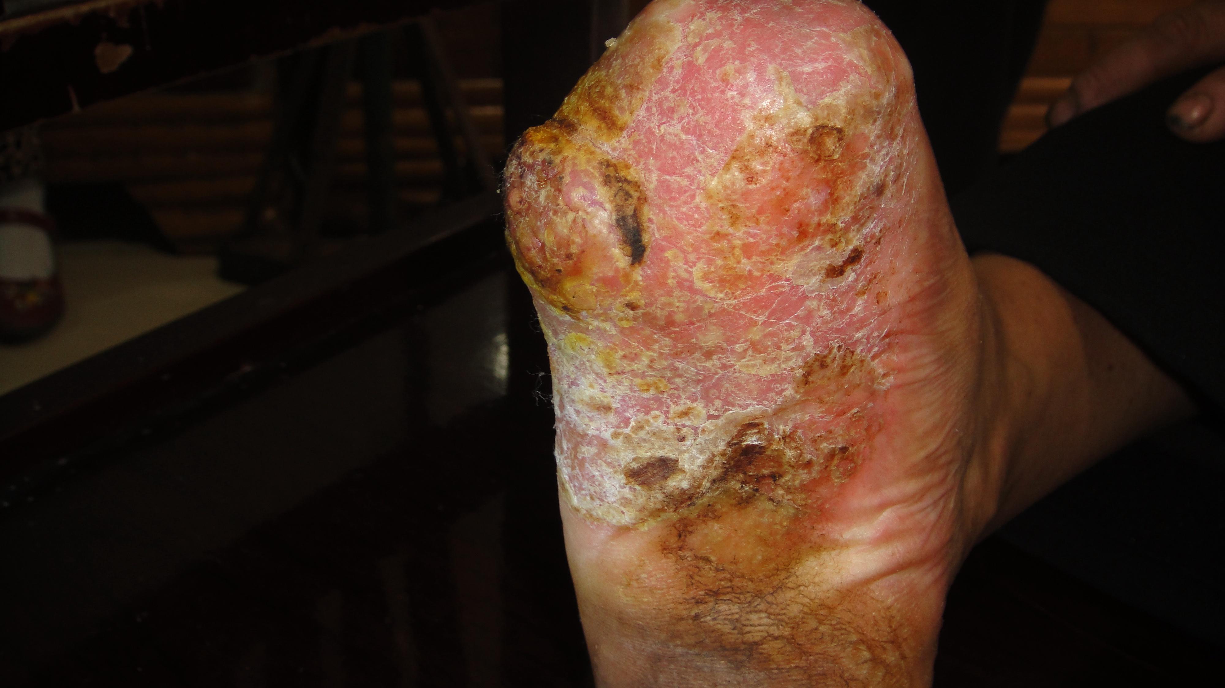 典型真菌感染——《春季皮肤病病例征集》活动