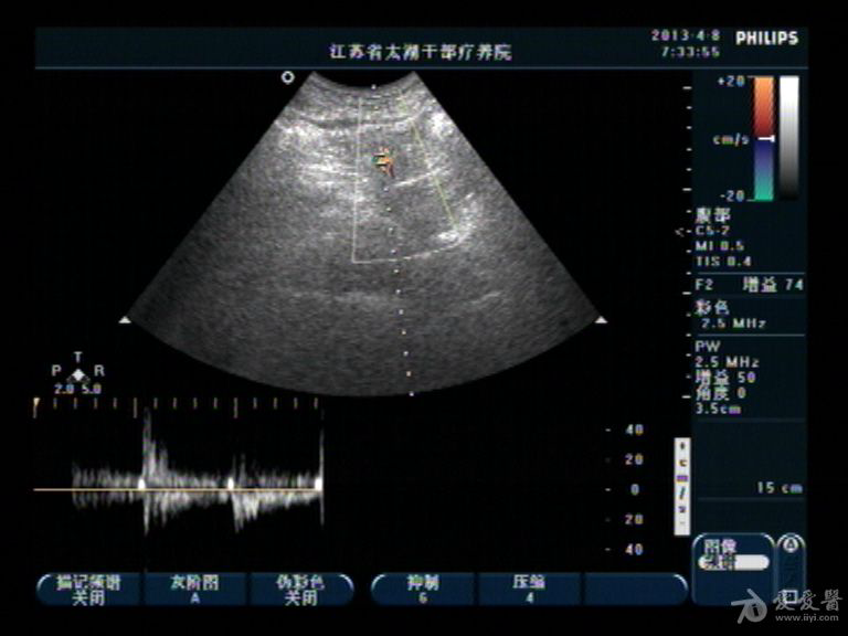 肠系膜上动脉的真性动脉瘤 超声医学讨论版 爱爱医医学论坛