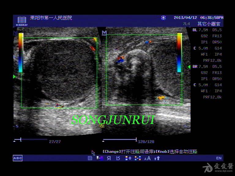 超声入门贴56睾丸扭转