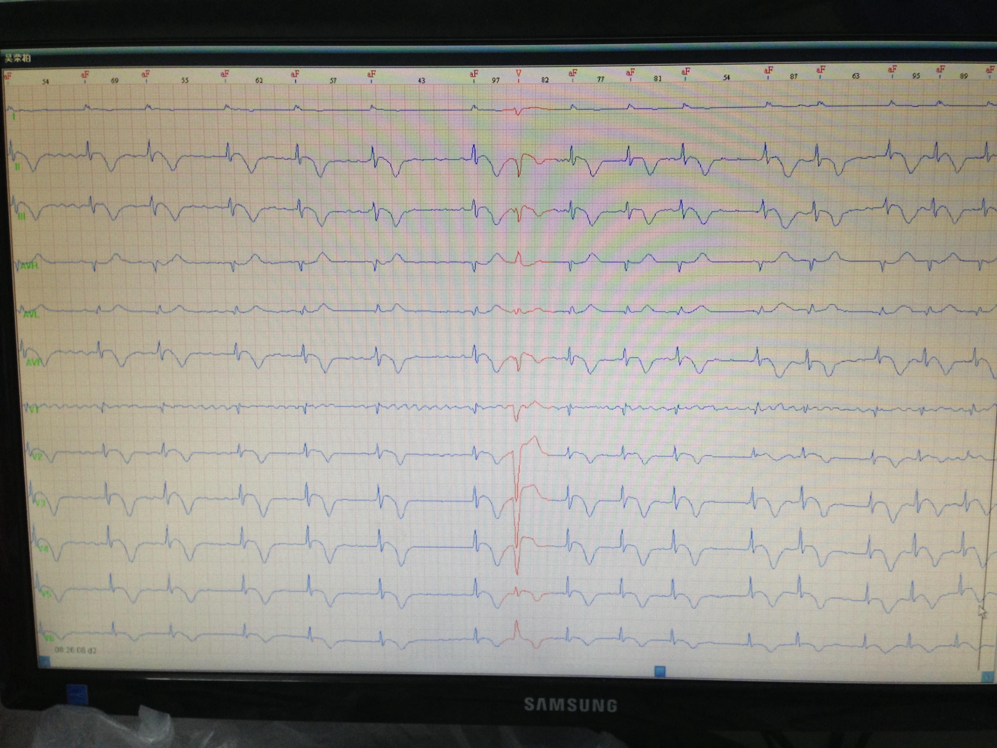 这是一份房颤的心电图 宽大畸形的到底是什么 如何具体鉴别 区别