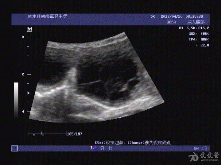 肝包虫病? - 超声医学讨论版 - 爱爱医医学论坛