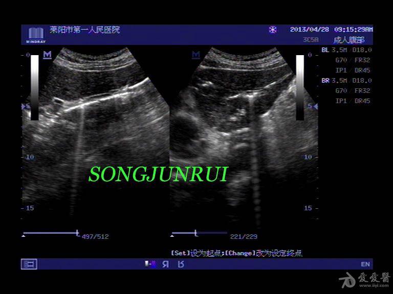 超声入门贴67-----肝内胆管积气