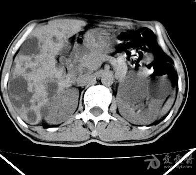 多囊肾多囊肝