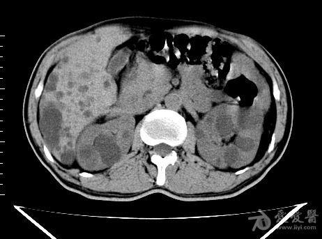 多囊肾多囊肝
