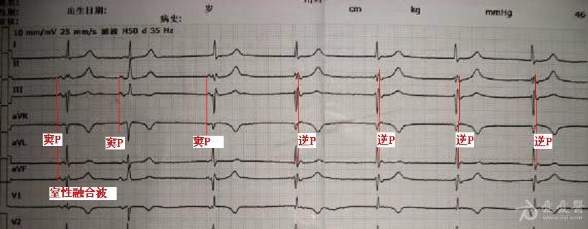 可儿9 -室性逸搏心律-室性融合波-2.jpg