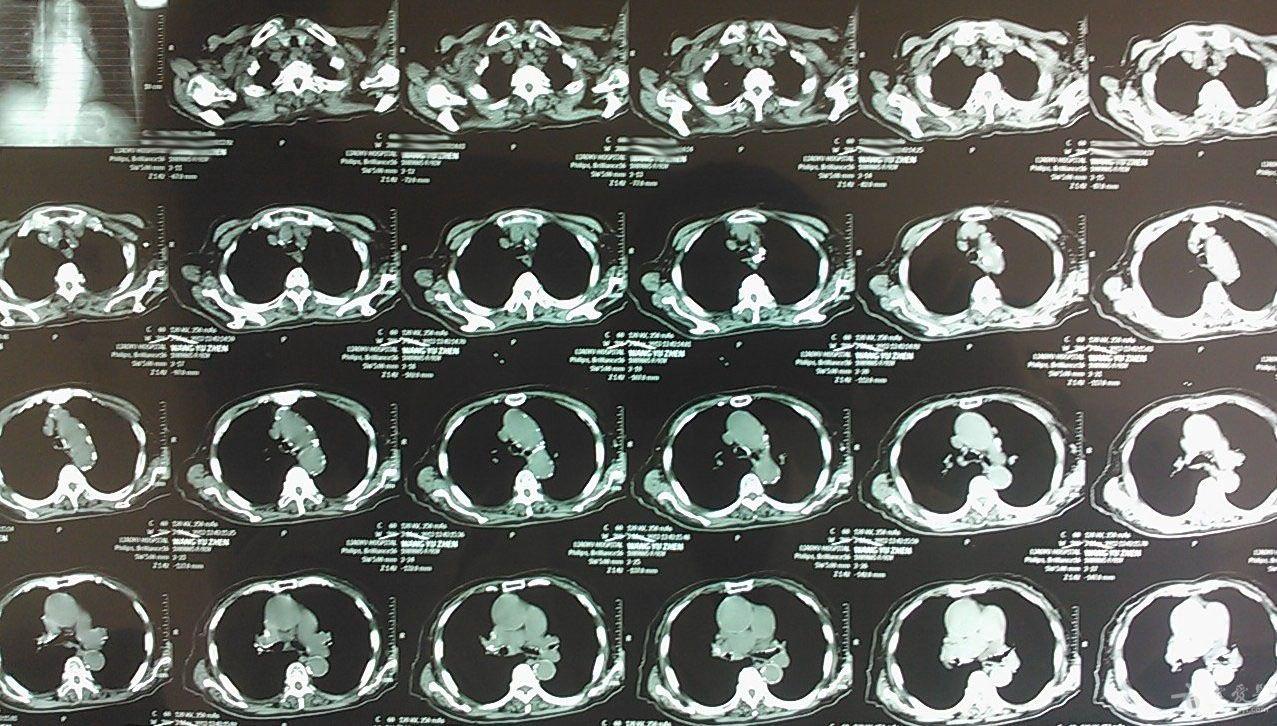 与ct相比,胸片会漏掉很多信息(有意想不到的进展)