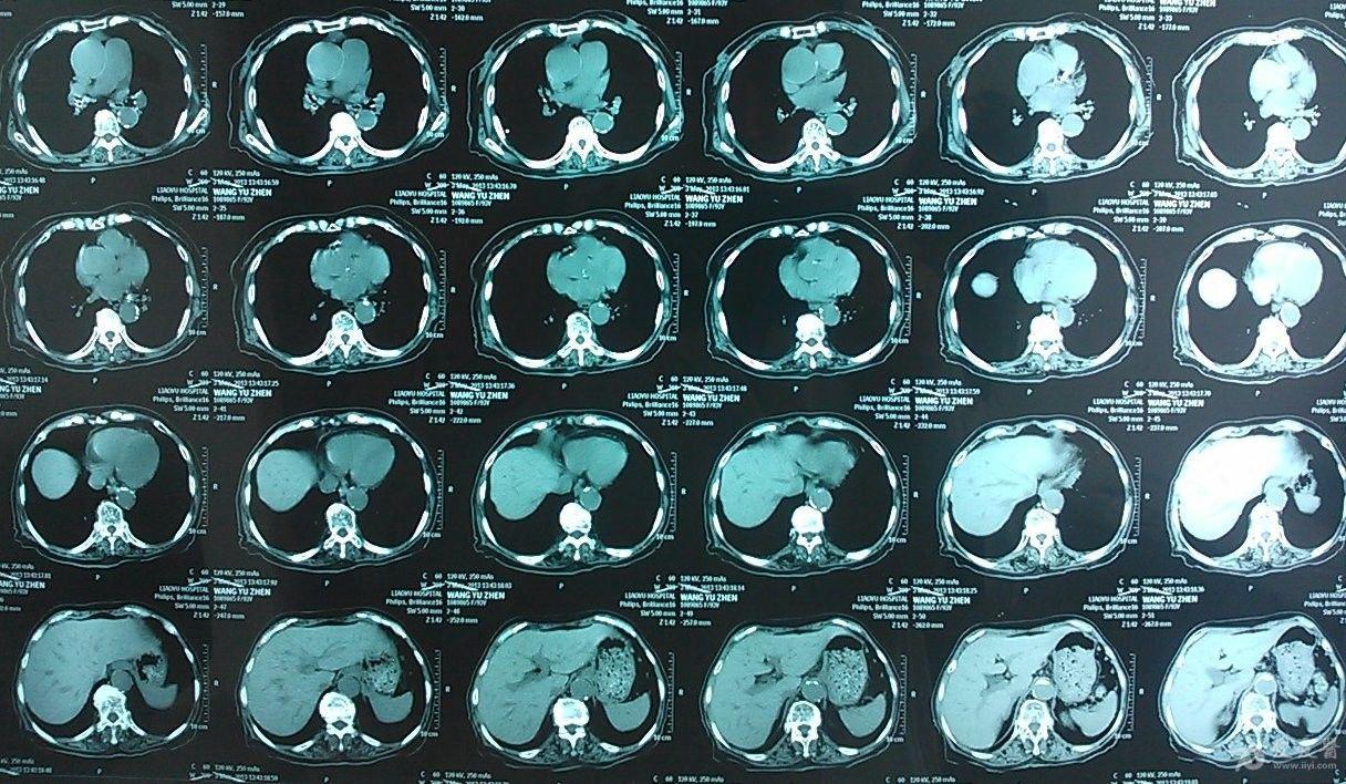 与ct相比,胸片会漏掉很多信息(有意想不到的进展)