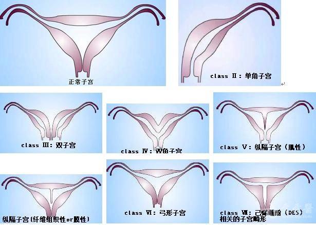 class Ⅲ:双子宫(didelphys uterus)  class Ⅳ:双角子宫(bicornuate