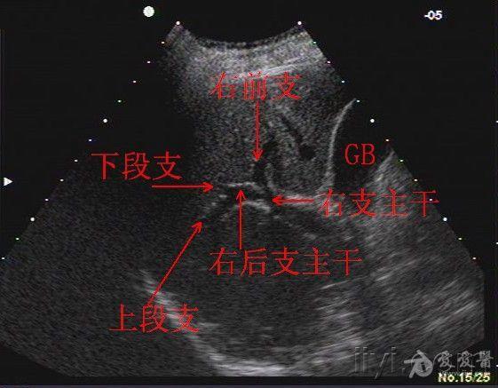 肝脏血管结构及分叶的详细图文解说 - 超声医学讨论版