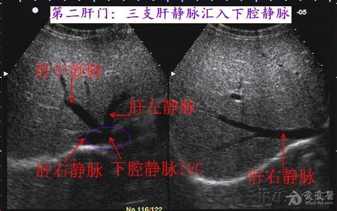 肝脏血管结构及分叶的详细图文解说