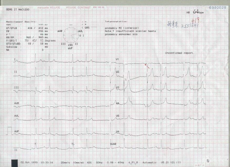 当地医院心肌酶检查异常(升高)   .心电图如上.   初步诊断