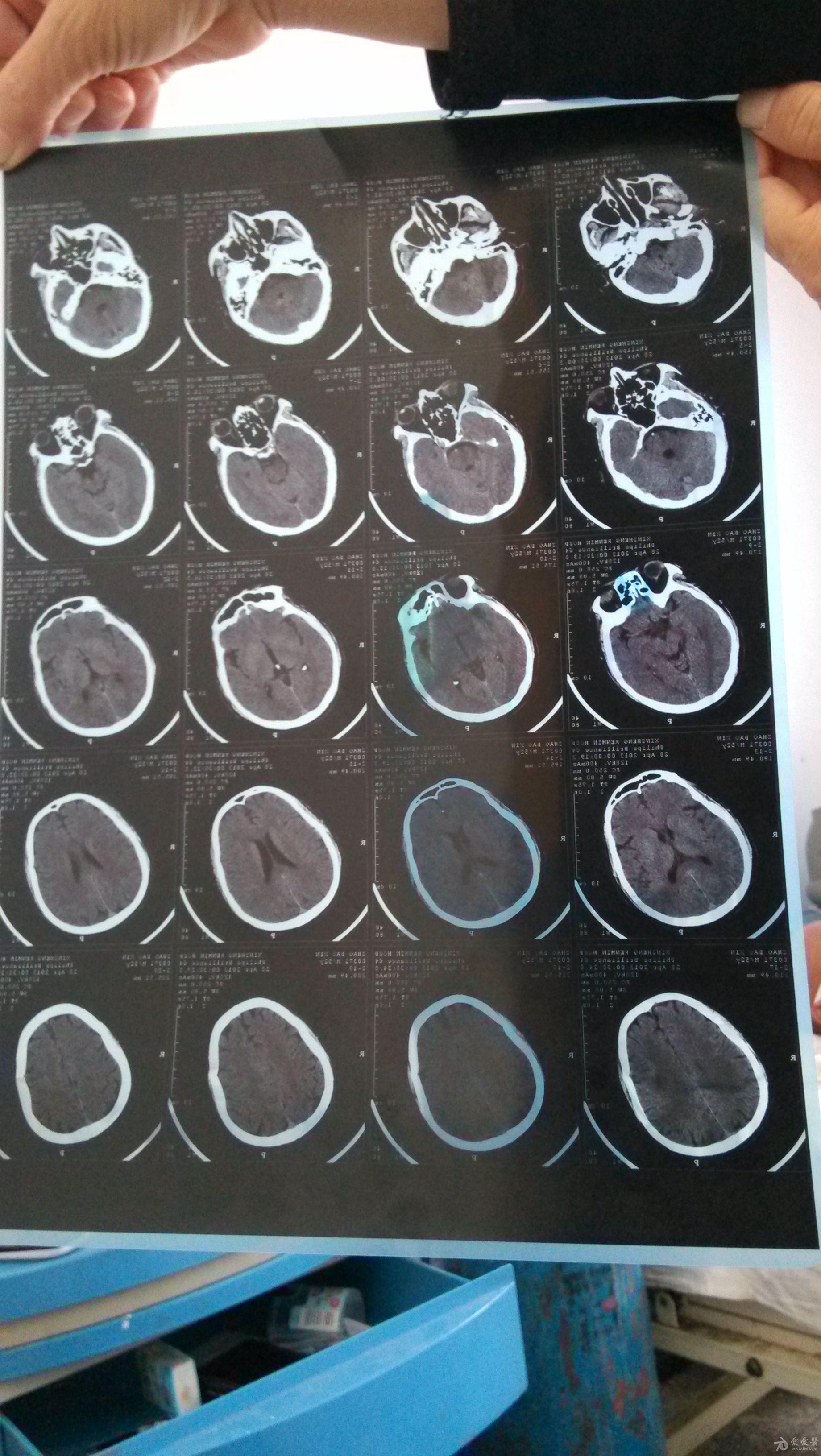 脑干梗塞病人求救急急急