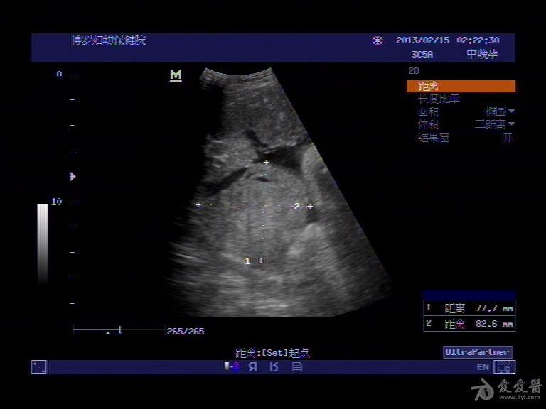 胎盘早剥一例 超声医学讨论版 爱爱医医学论坛