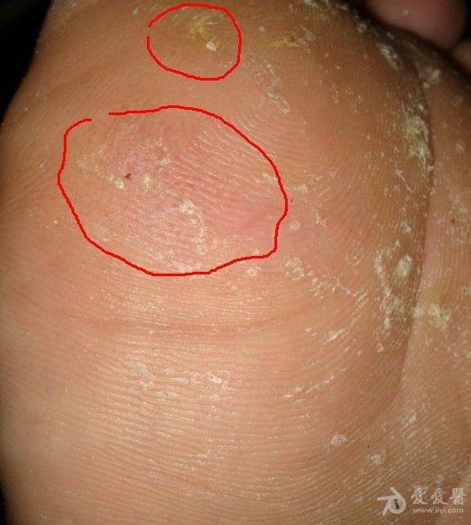 有图脚底这是湿疹还是真菌感染还是别的什么