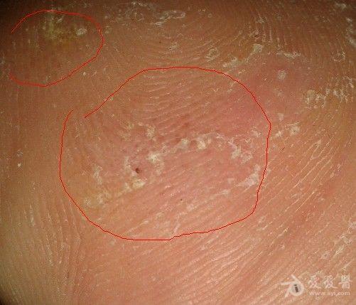 有图,脚底这是湿疹还是真菌感染还是别的什么?