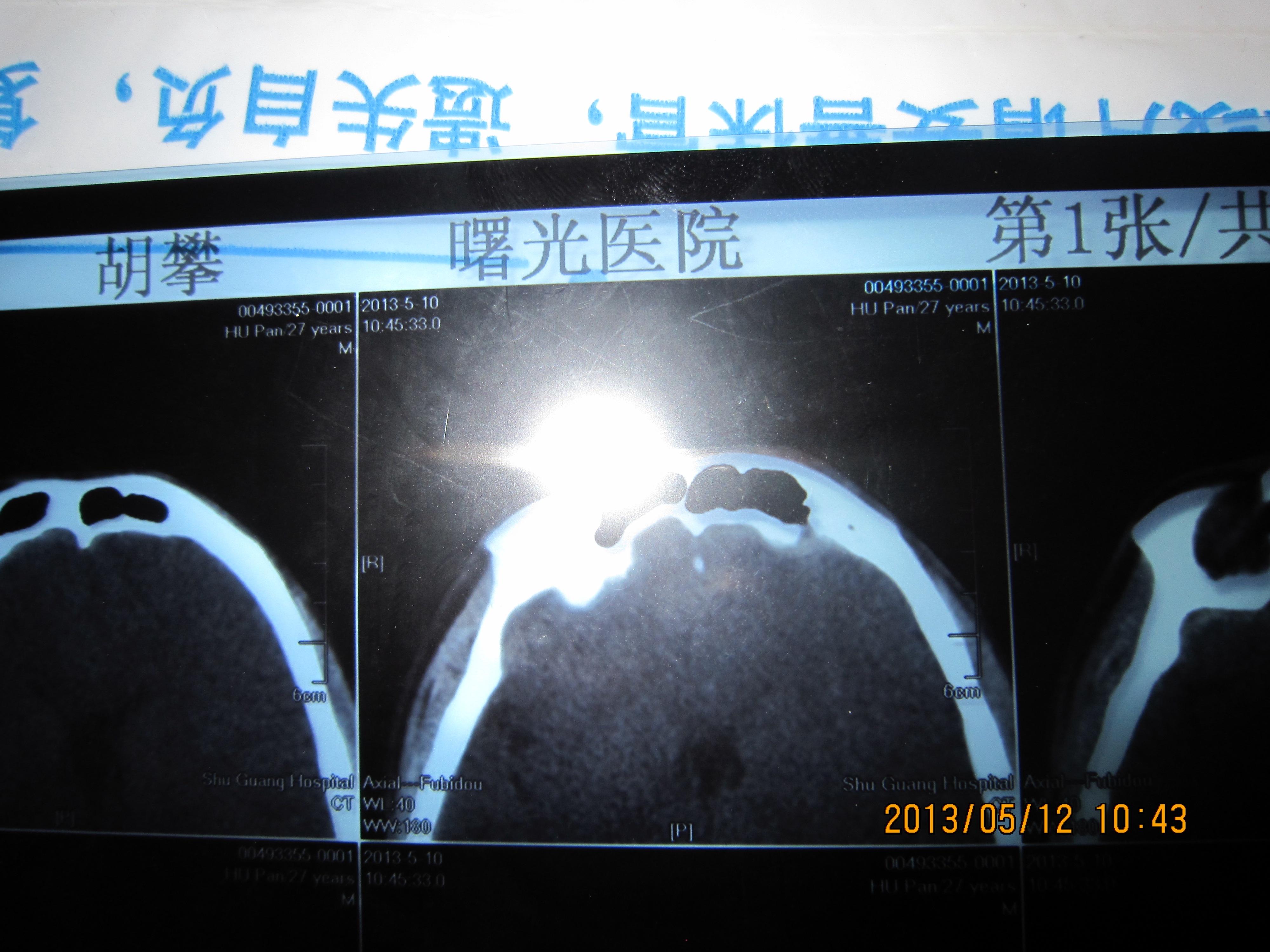 无头痛,头晕以及别的症状额骨偏右侧致密影,考虑骨瘤