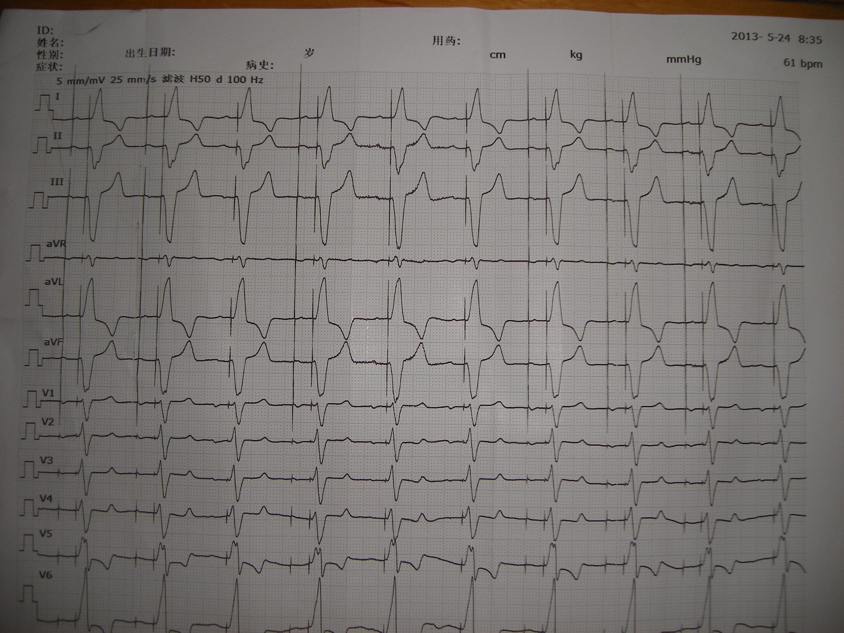 请版主和高手帮忙看起搏器心电图