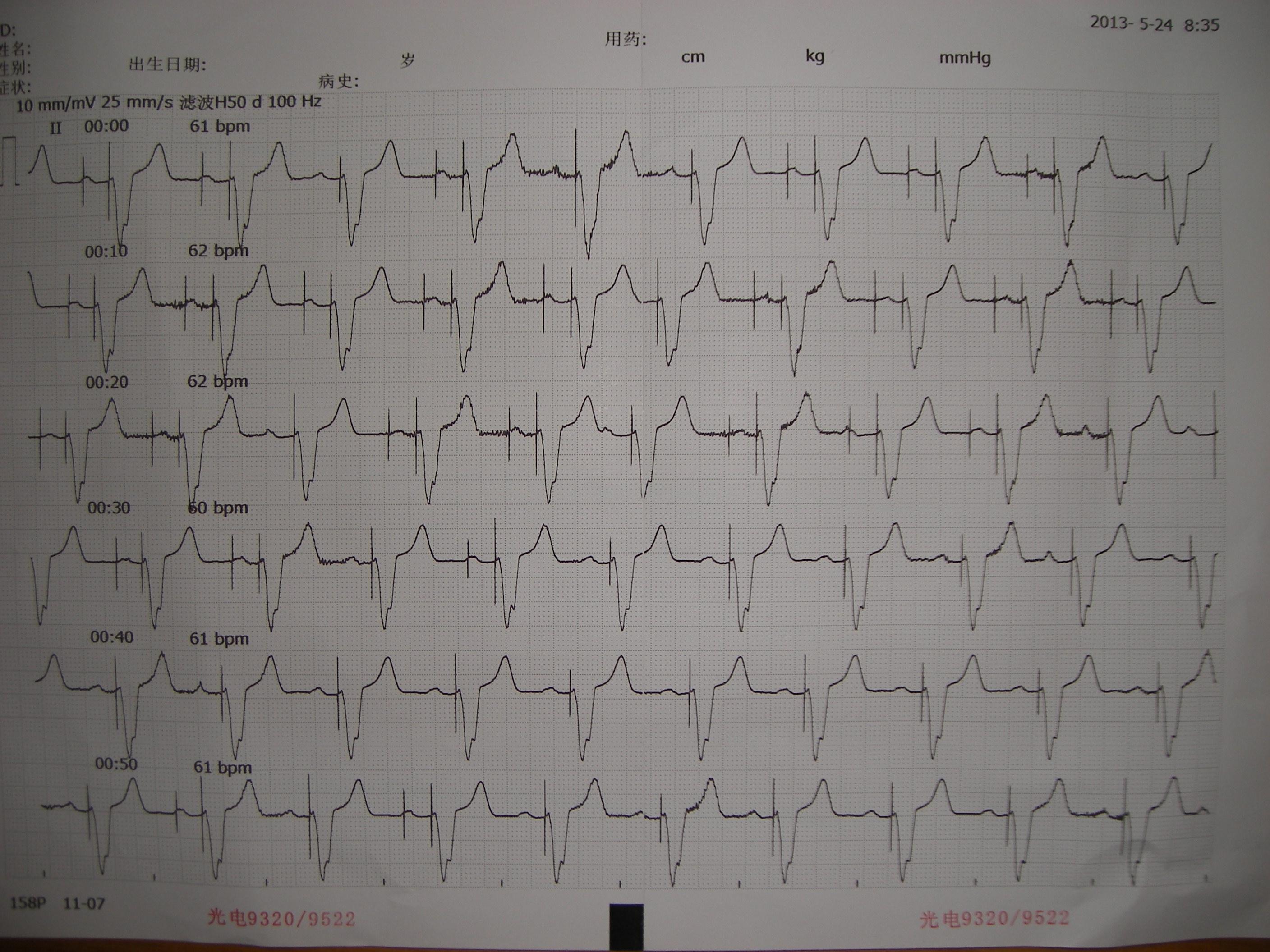 请版主和高手帮忙看起搏器心电图