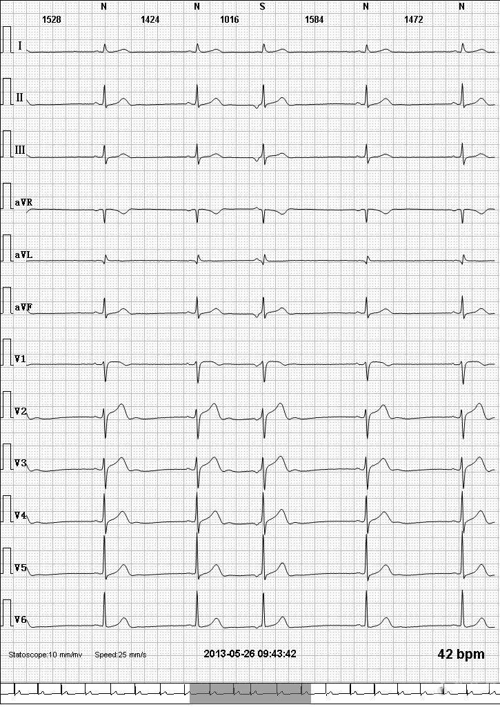 请版主老师看看这份心电图如何诊断