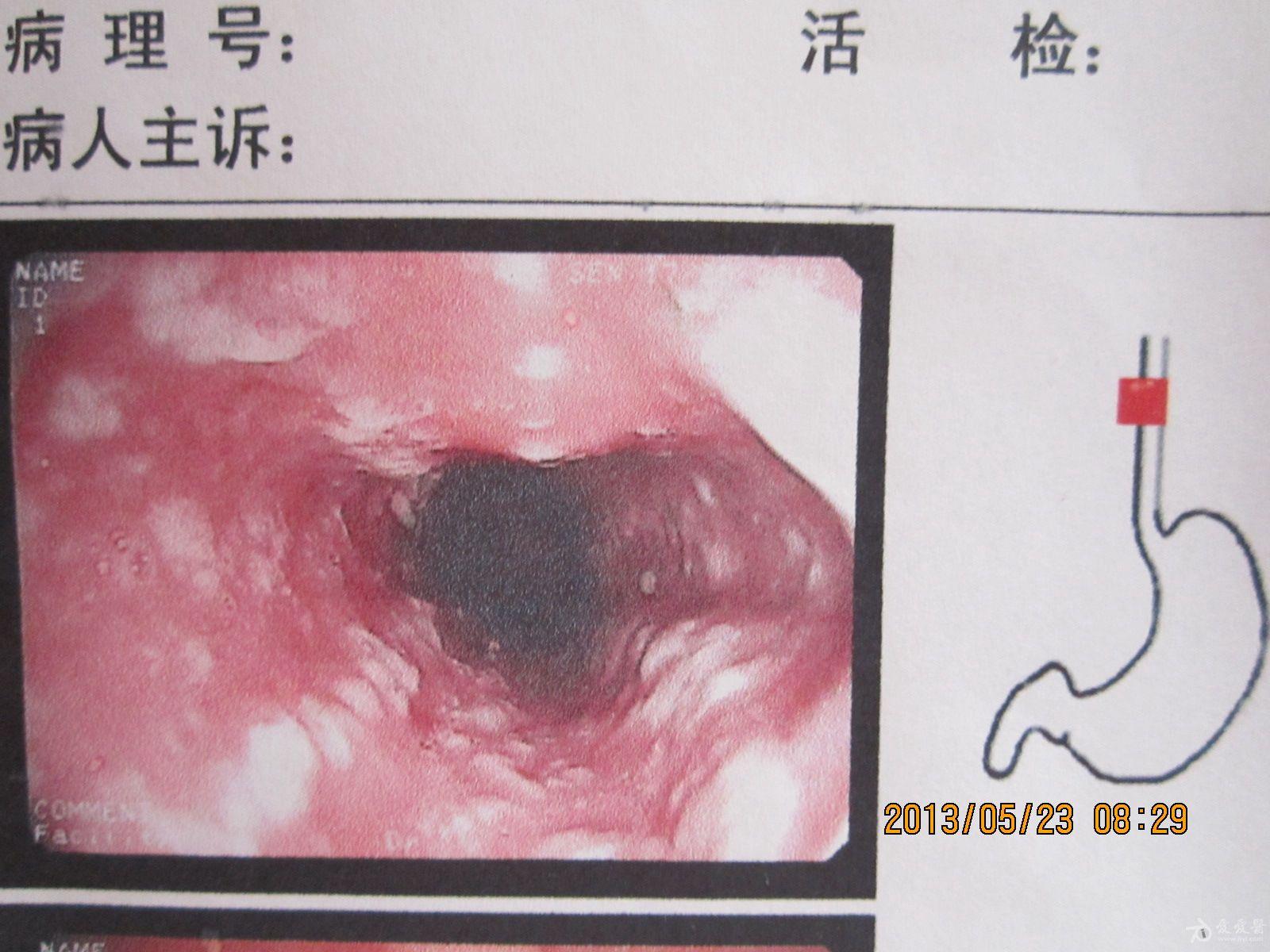 霉菌性食管炎59例临床分析