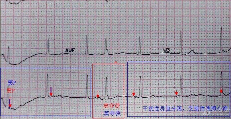 讨论心电图-31(风心术后)