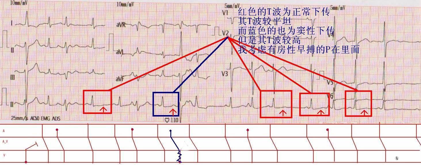 求各位老师给看看是不是窦房传导阻滞 心电图脑电图专业讨论版