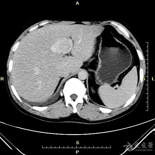 上腹部ct,请会诊.