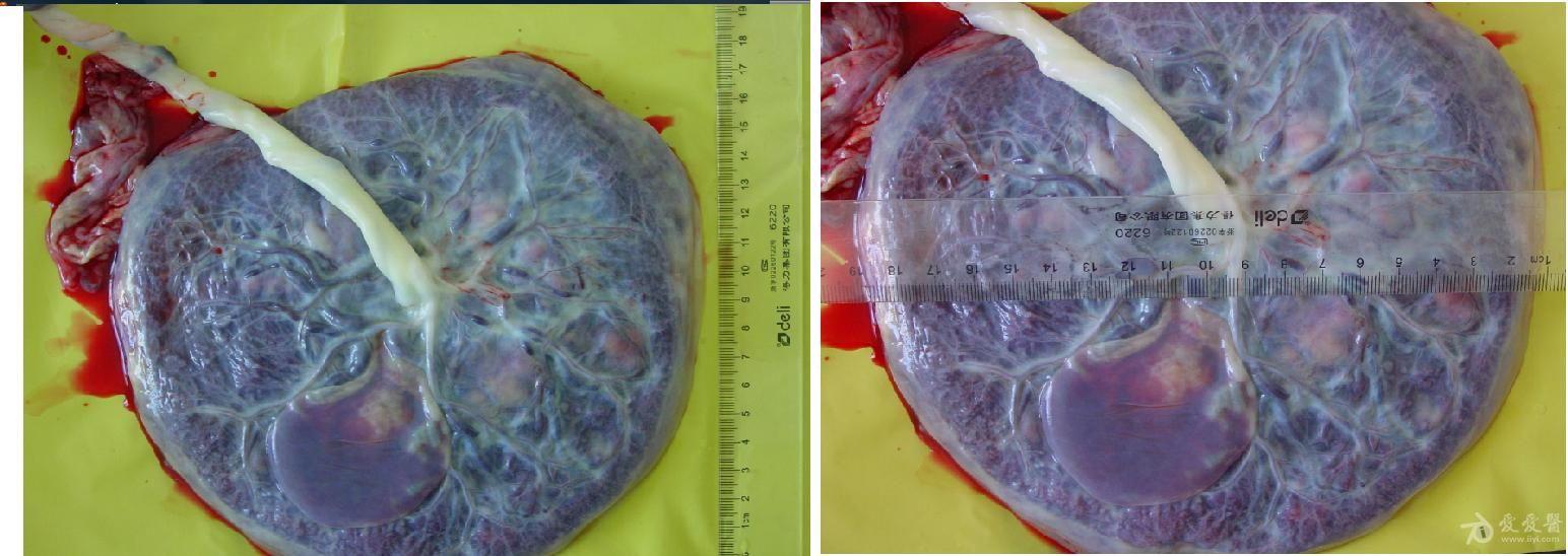 羊膜腔内囊性占位,追踪标本--胎盘囊肿