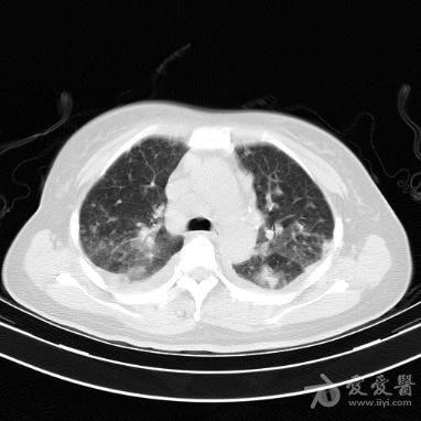 肺内多发斑片影?