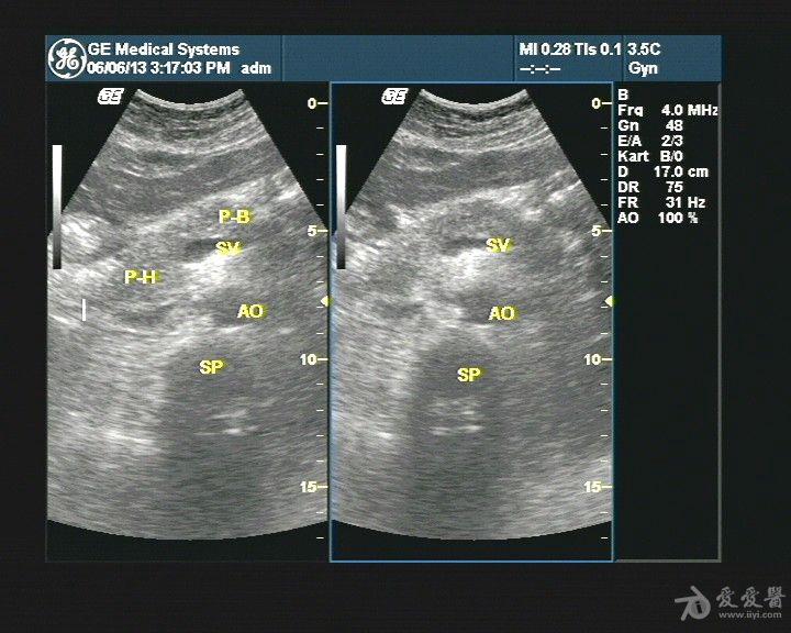 胰腺尾部囊性占位 超声医学讨论版 爱爱医医学论坛