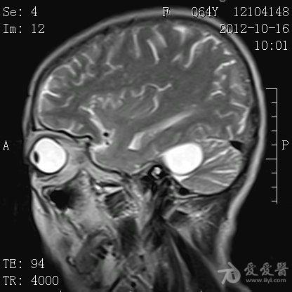 左侧桥小脑角区占位性病变mri