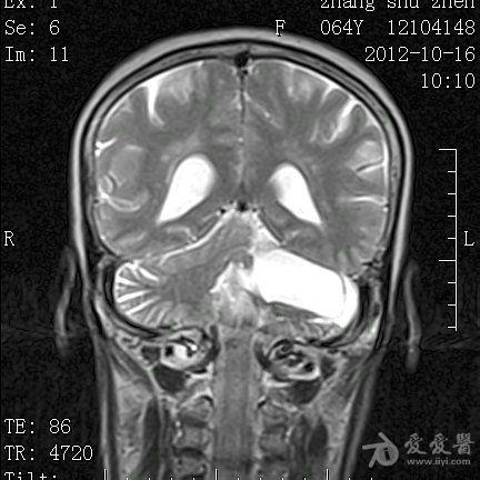 左侧桥小脑角区占位性病变mri