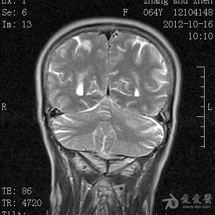 左侧桥小脑角区占位性病变mri