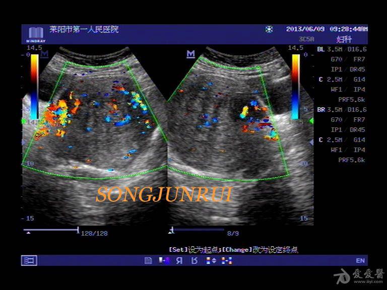 超声入门贴101-----子宫腺肌症