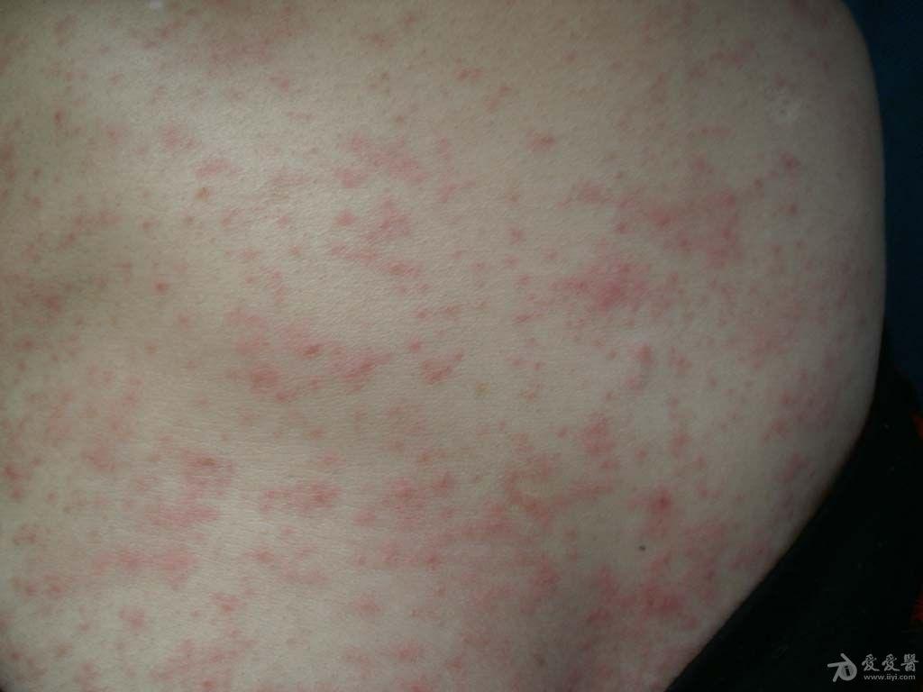 皮肤病成人麻疹