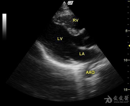 永存左上腔静脉 - 超声医学讨论版 - 爱爱医医学论坛