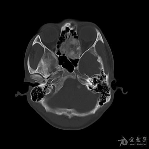 病例27砂粒体样骨化性纤维瘤