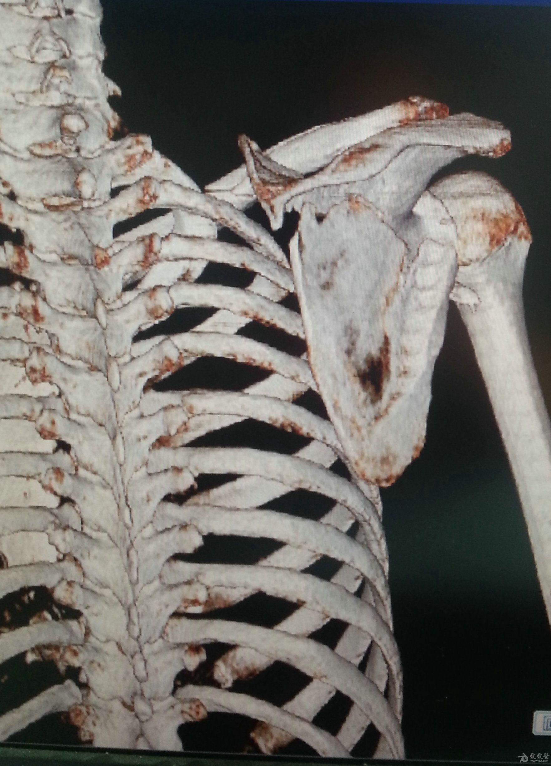 肩胛骨横行骨折锁骨粉碎骨折肩峰骨折如何处理