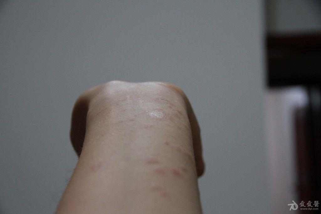 3例玫瑰糠疹治疗经验介绍