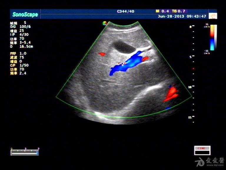 第一肝门区一例低回声肿块的讨论 - 超声医学讨论版